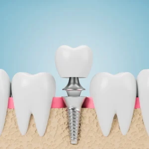 Implanty dentystyczne Warszawa